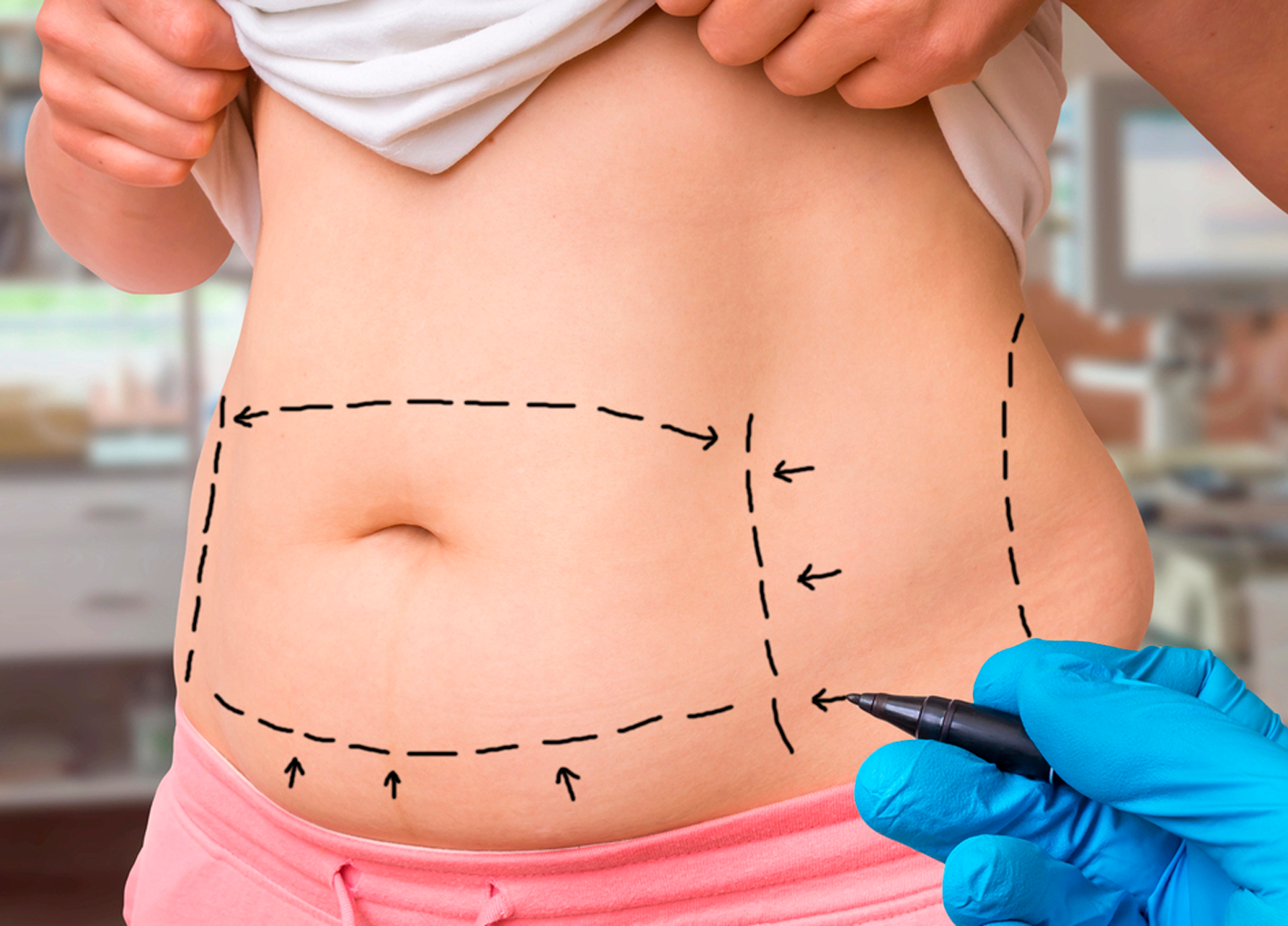 Lipoaspiração
